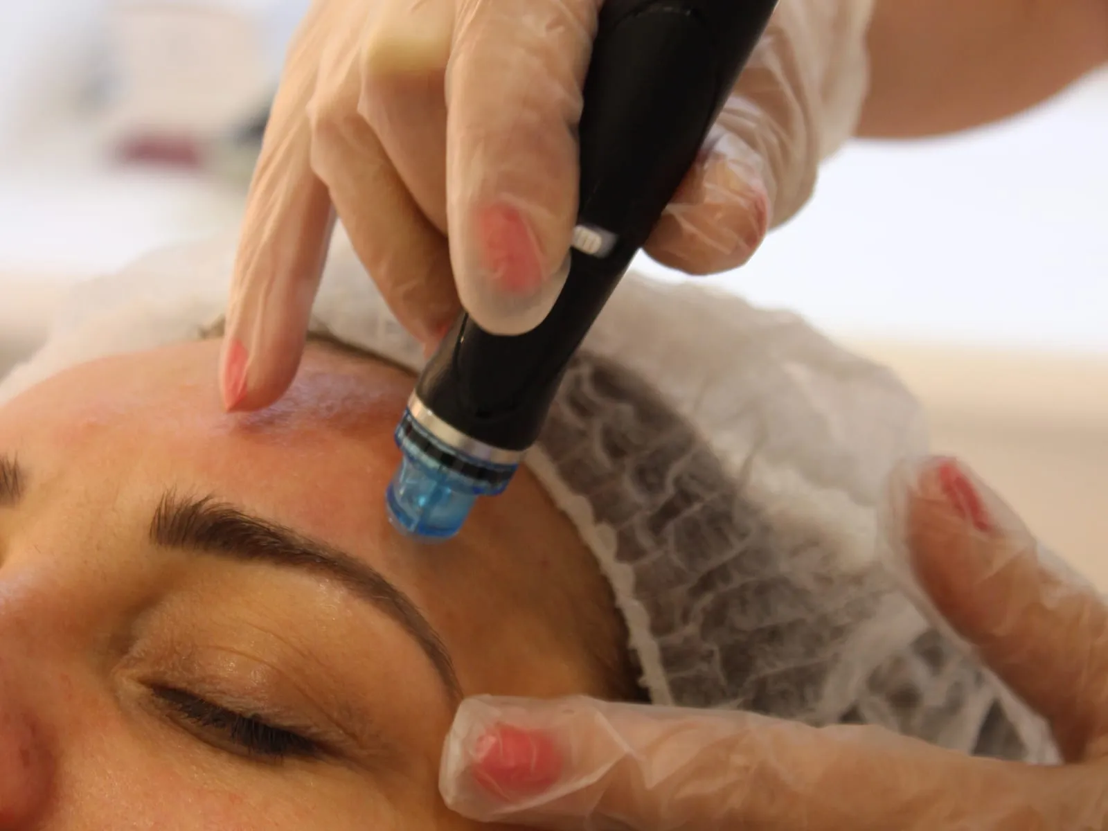 Процедура Hydrafacial: наконечник аппарата скользит по лбу пациентки