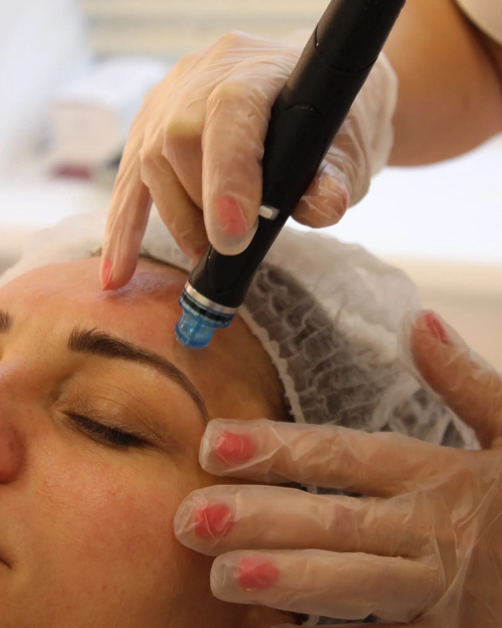 Procedura Hydrafacial: vârful aplicatorului trece pe fruntea pacientei